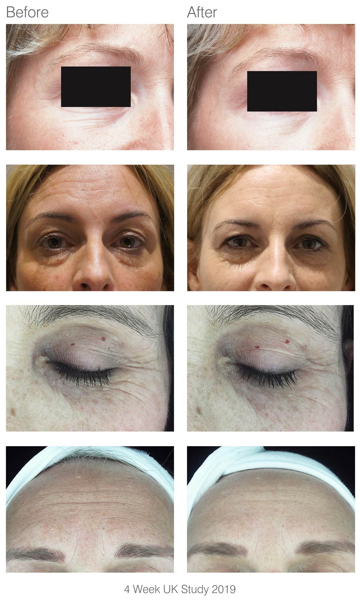 side by side before and after studies from people who have used facelite beauty boosting LED face mask with now visibly reduced wrinkles