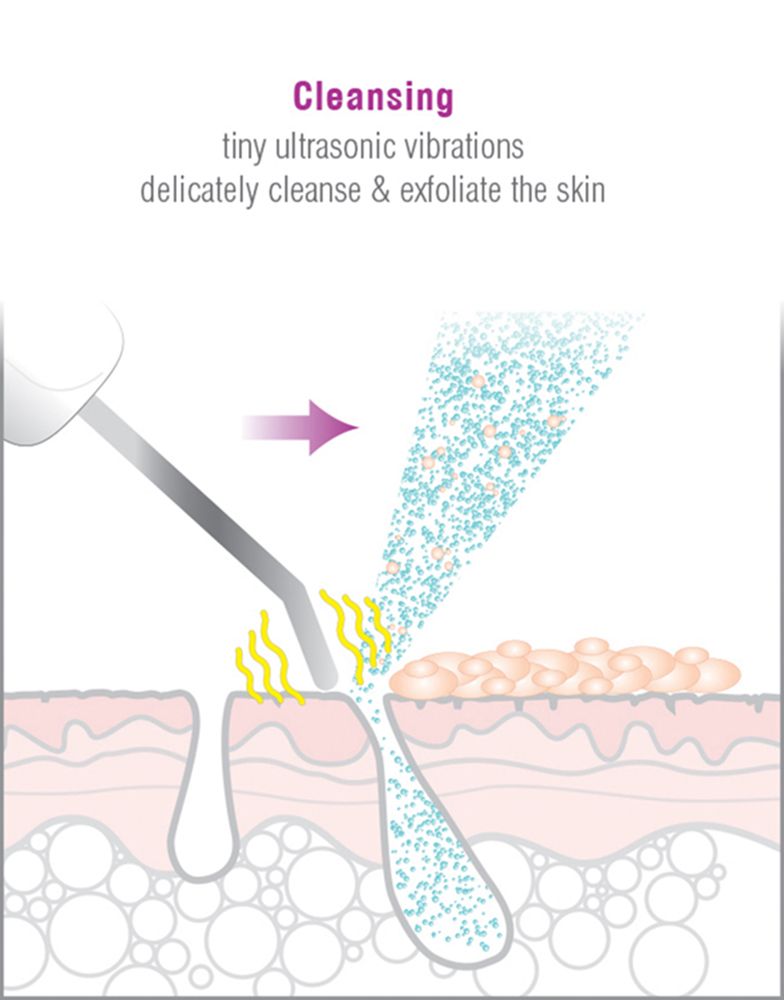 diagram illustrating how the ultrasonic vibrations from the blade placed angled against the skin delicately cleanses and exfoliates