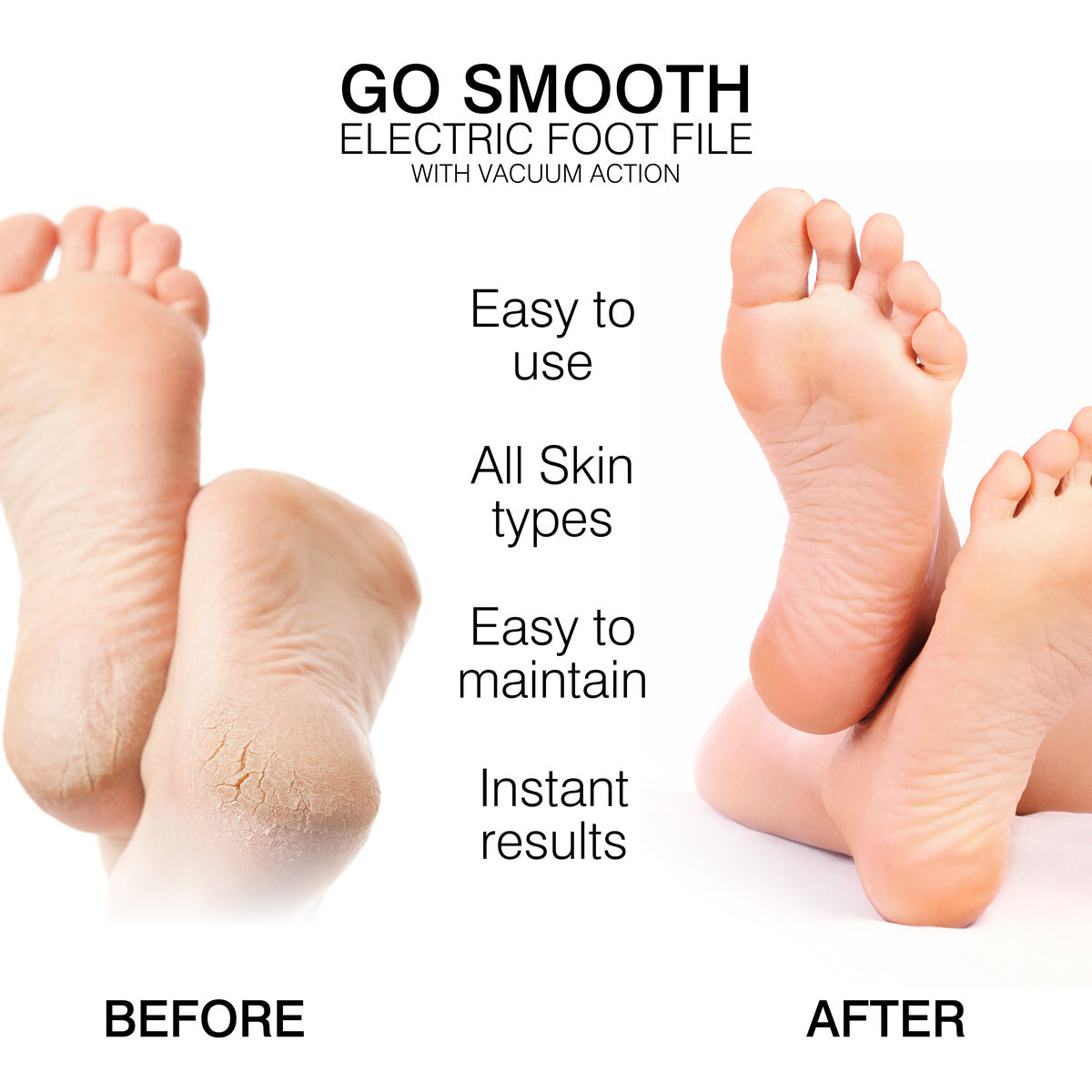 Before and after image of feet shows dry, cracked heels transformed to smooth, healthy ones, highlighting the benefits of using Rio Go Smooth Electric Foot File Hard Skin Remover with Vacuum Action for removing dry skin.