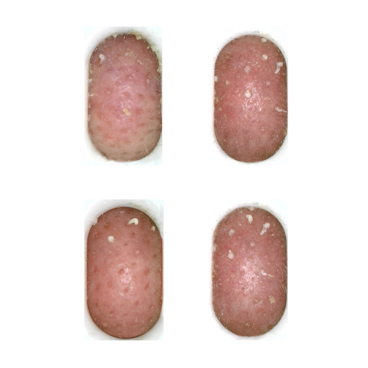 camera feed images of sebum plugs blackheads and spots being gently sucked out using the large treatment head on the pore perfection