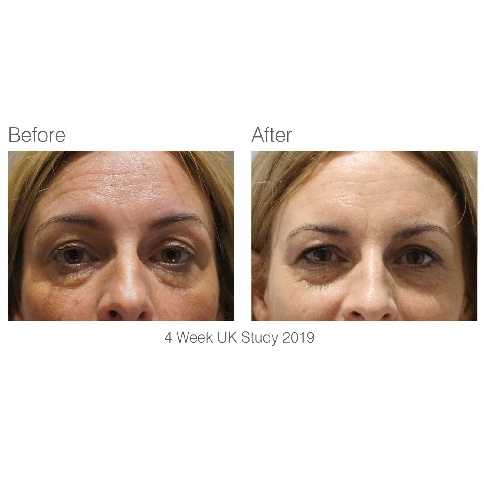 before and after 4 week study of eye and midface area with visibly reduced wrinkles more youthful skin after using facelite beauty boosting LED face mask